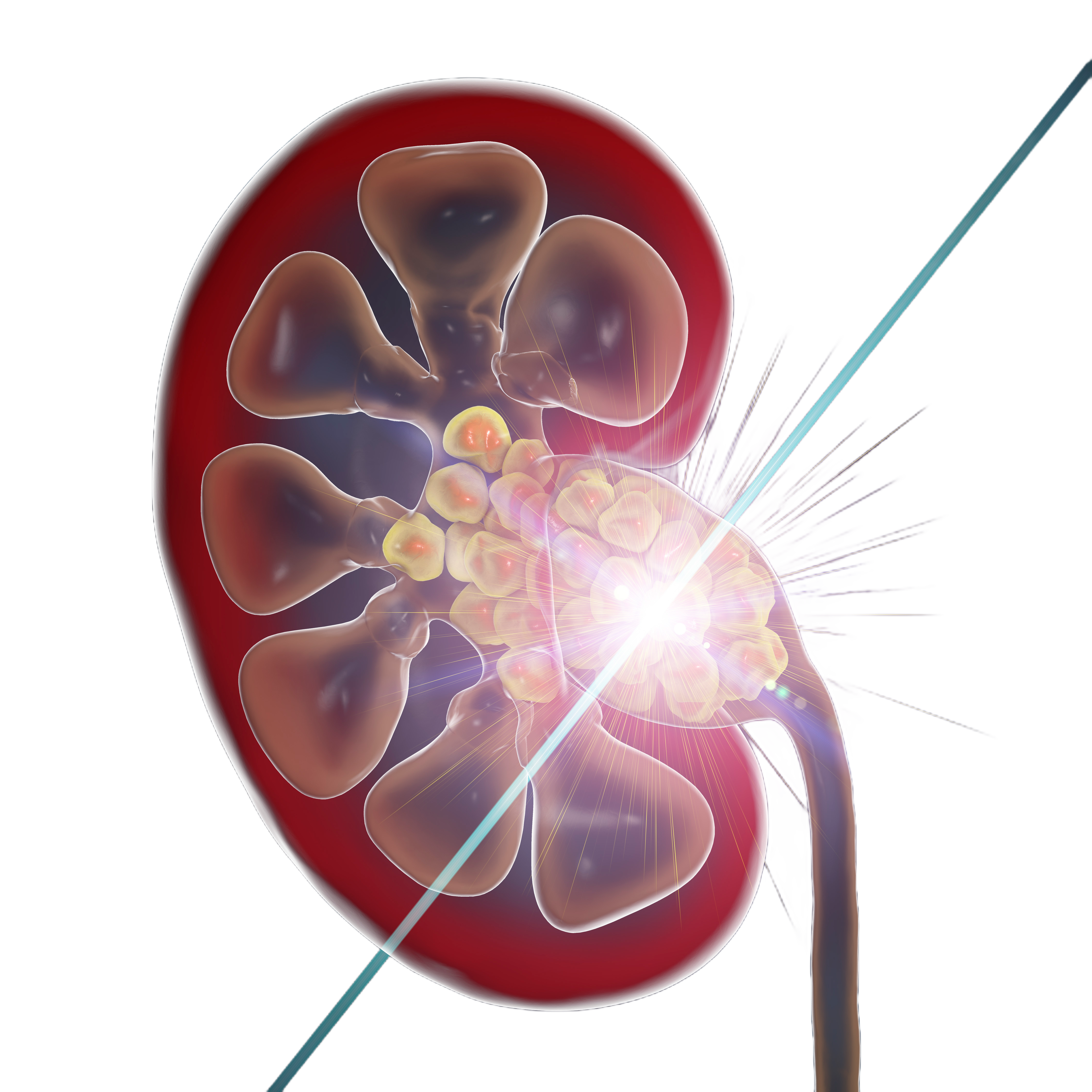 https://lasers-robotics.com/wp-content/uploads/2024/06/Laser-kidney.png