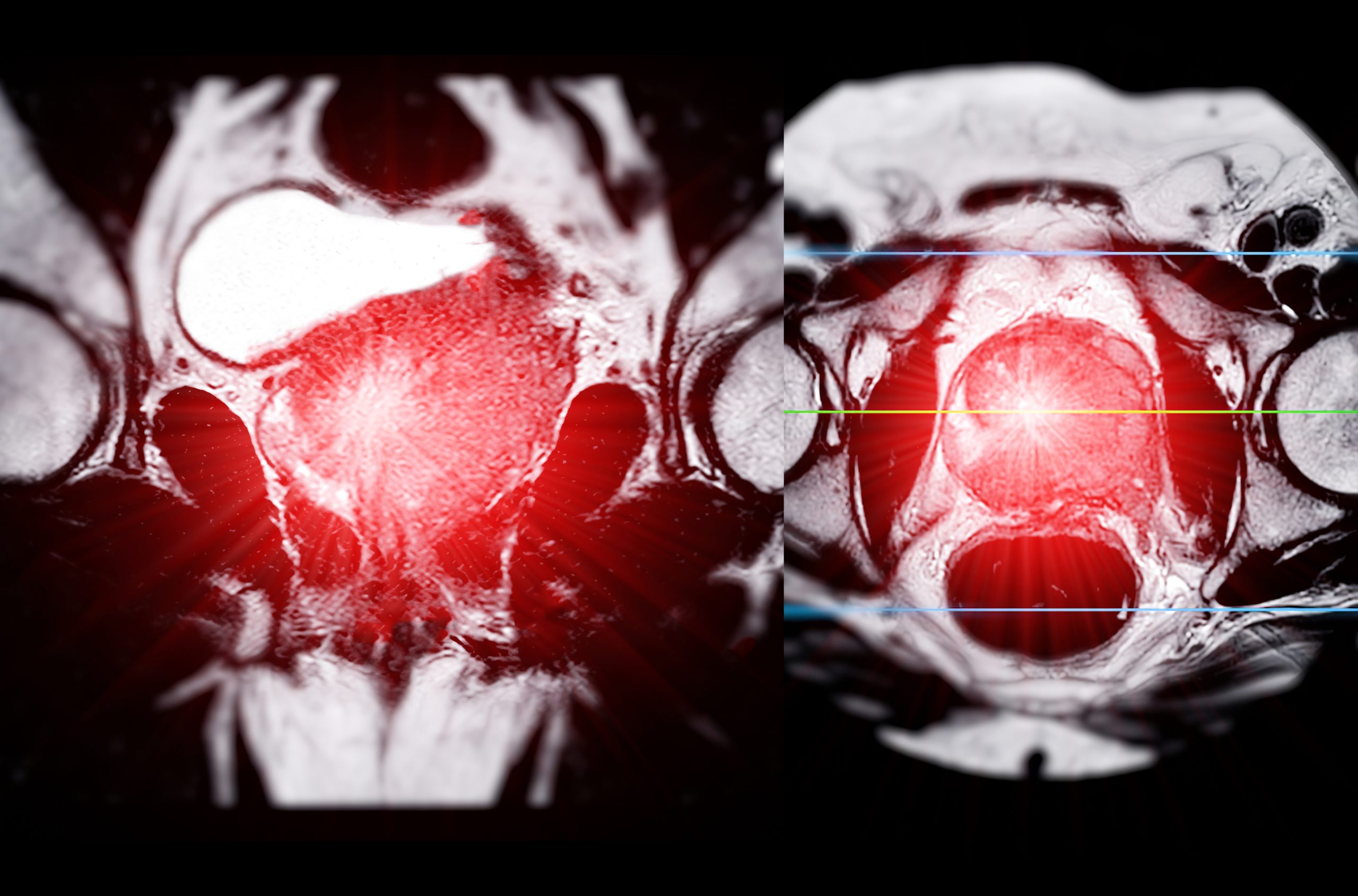 MRI of the prostate gland reveals a focal abnormal signal intensity (SI) lesion at the left posterolateral peripheral zones at the apex, aiding in diagnosing tumors and guiding treatment decisions.