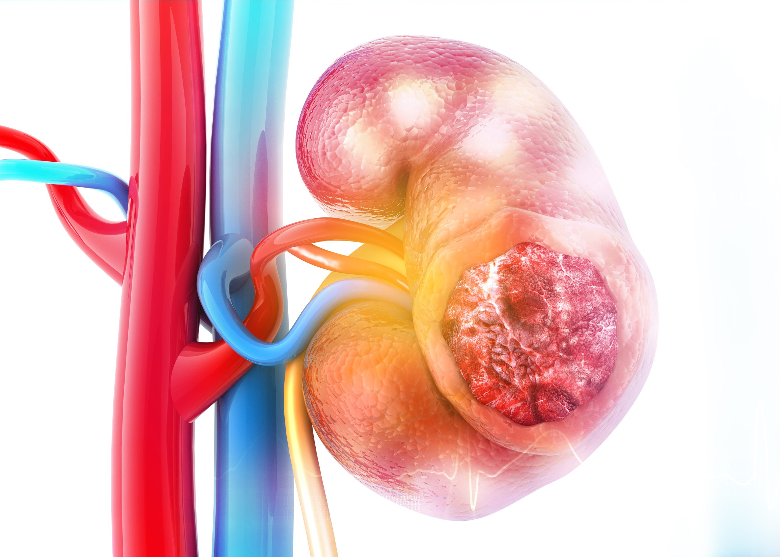 Diseased human kidney on science background. 3d illustration